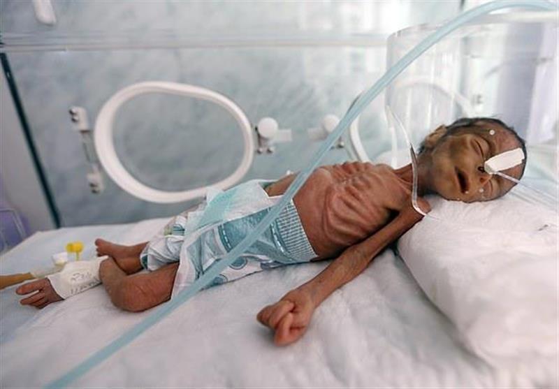 ابتلای 400 هزار کودک یمنی به سوء تغذیه شدید در نتیجه حملات عربستان