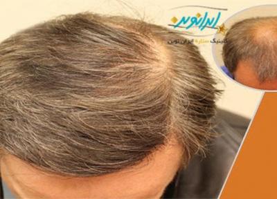 جدیدترین روش کاشت مو در کلینیک ستاره ایران نوین